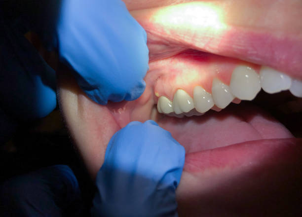 Best Emergency Denture Repair in Goulding, FL
